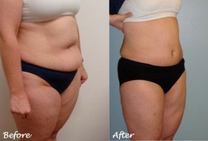 cavitation weight loss